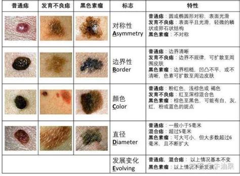 身體:acsf1ltef_m= 痣的位置|痣是什麼？會變成黑色素瘤？7種一定要除的痣